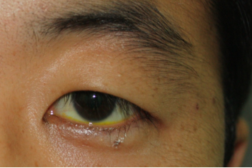 Before